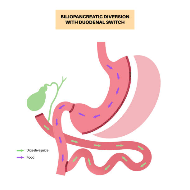 Biliopancreatic Diversion