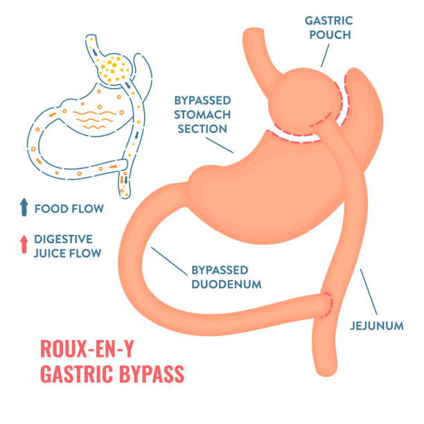 Gastric ByPass Roux-En-Y