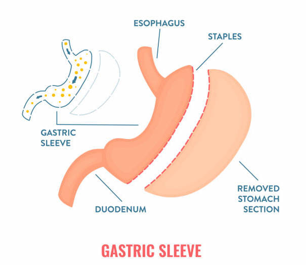 Gastric Sleeve